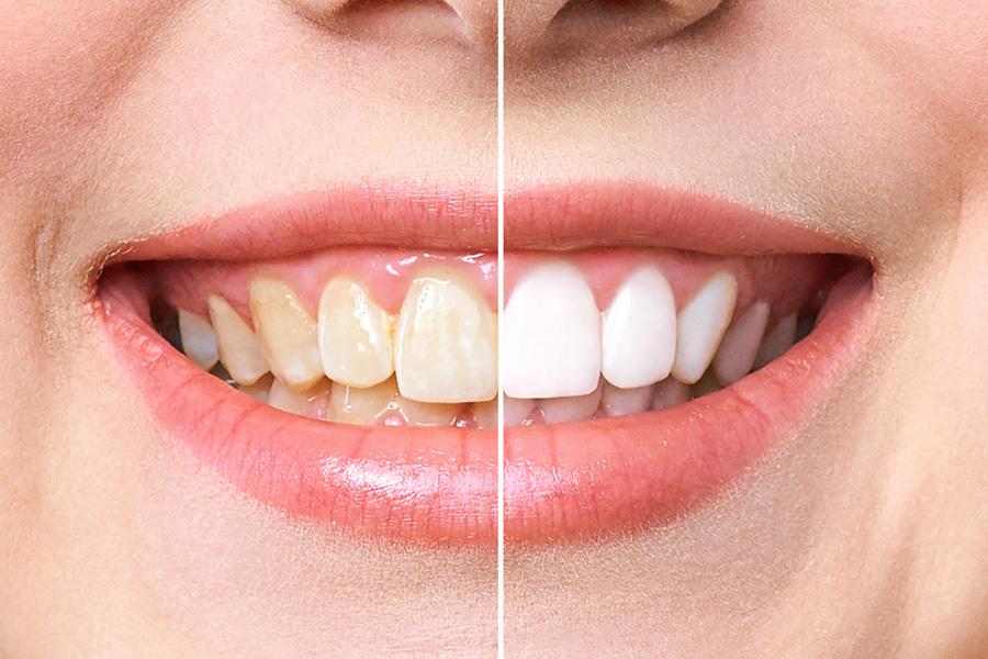 verschil van tanden